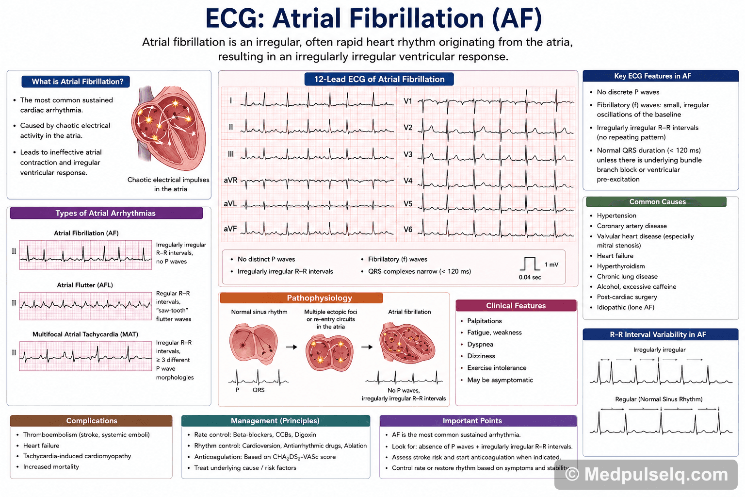 Atrial fibrillation — ECG