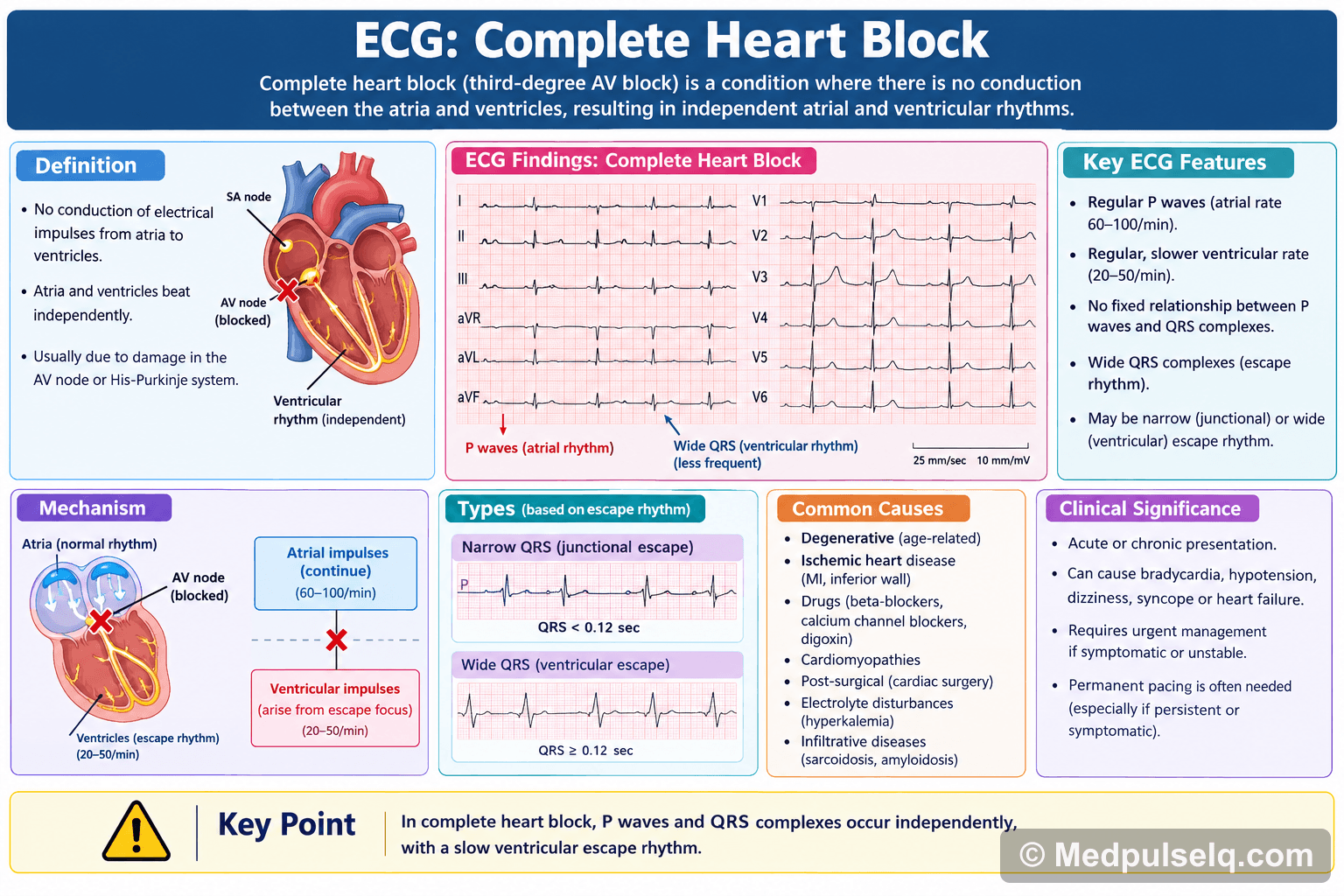 Complete heart block — ECG