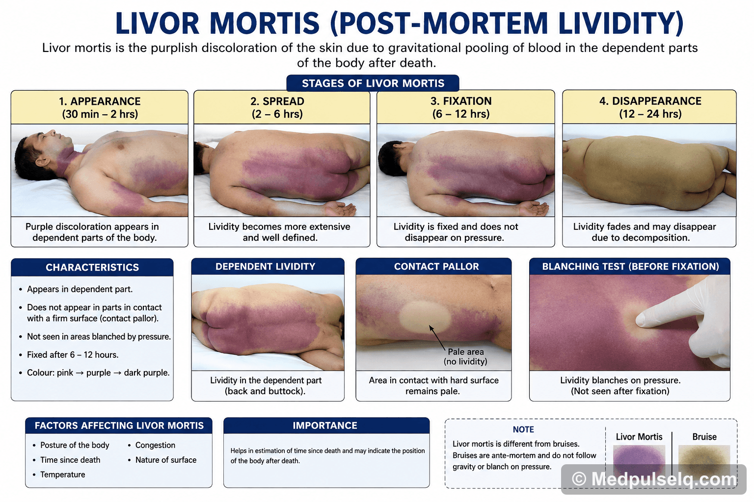 Post-mortem lividity — Forensic Medicine