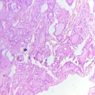 Thyroid gland