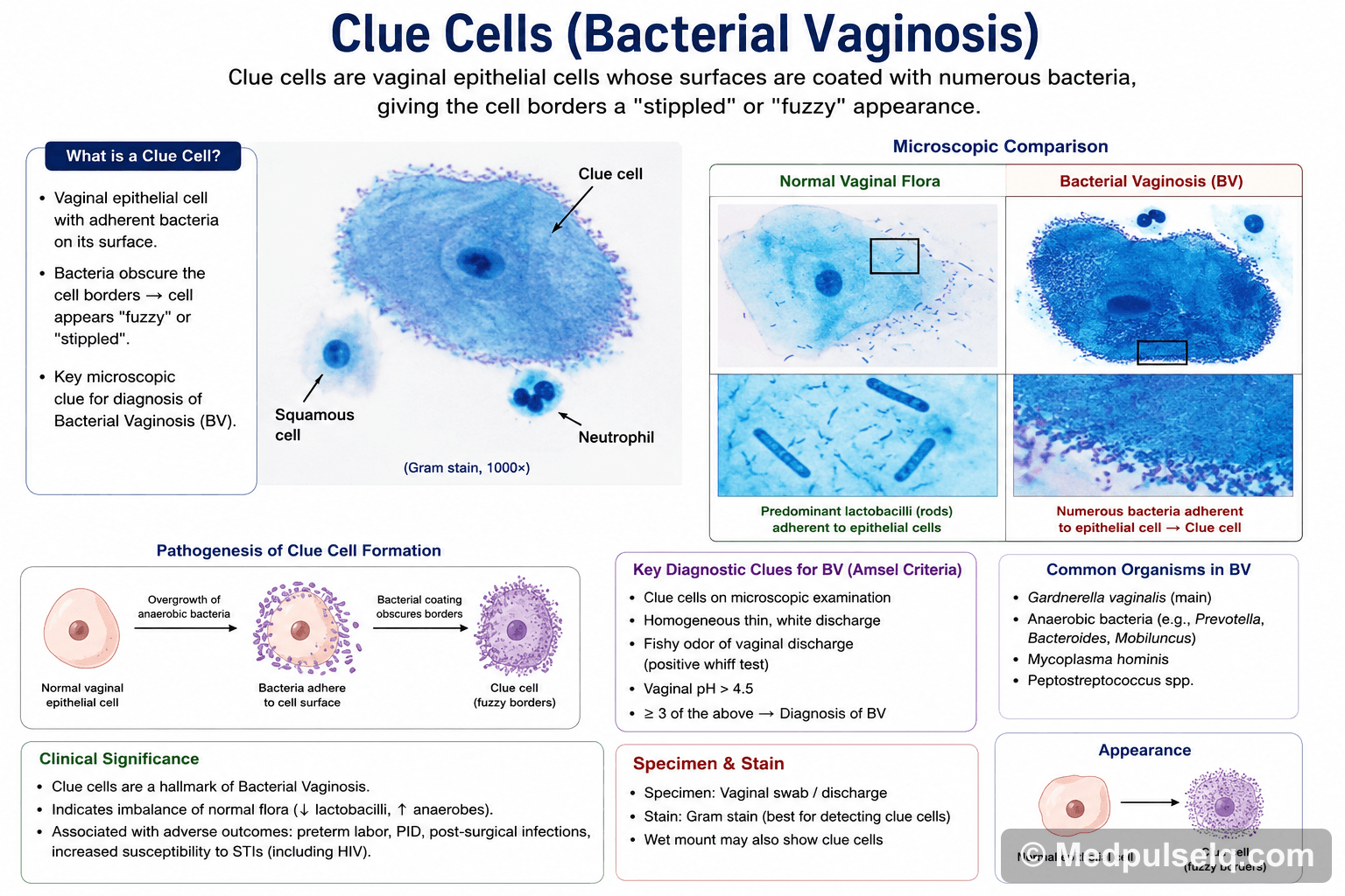 Clue cells (BV) — Microbiology