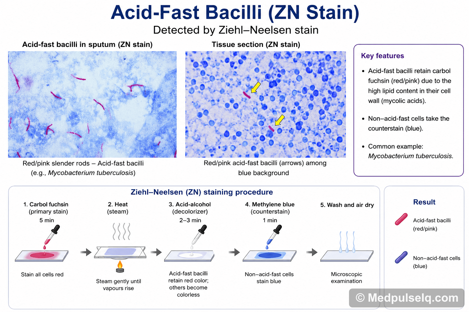 Acid-fast bacilli (ZN stain) — Microbiology