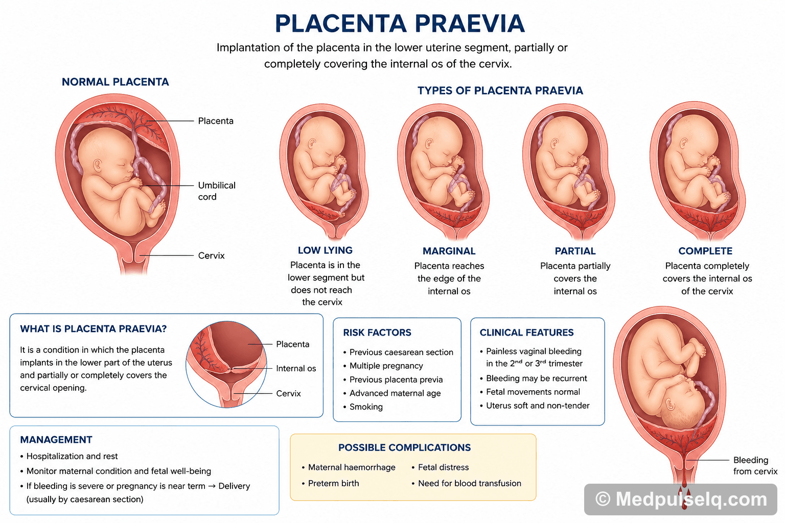 Placenta praevia — Obstetrics & Gynaecology