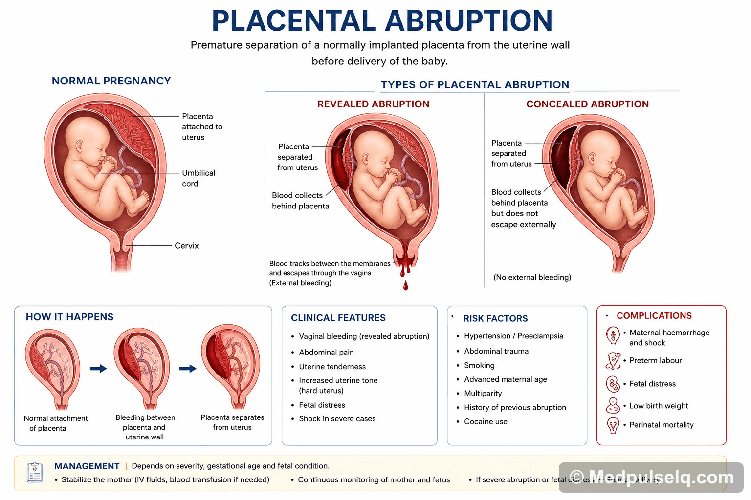 Placental abruption — Obstetrics & Gynaecology