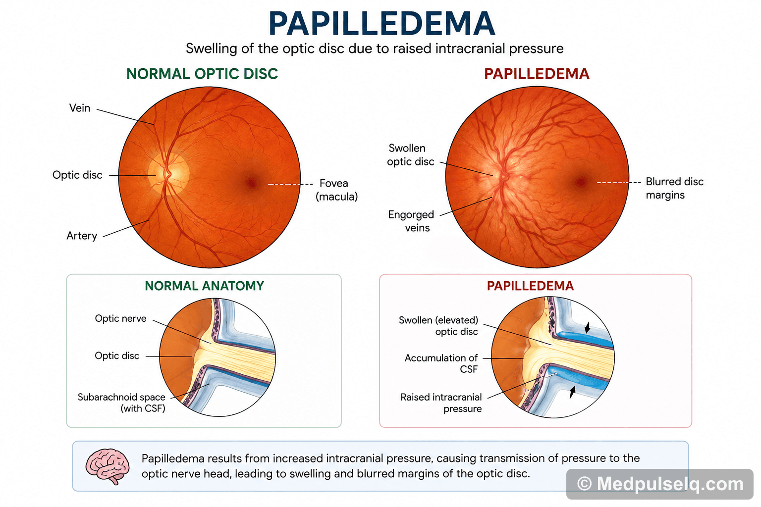 Papilloedema — Ophthalmology