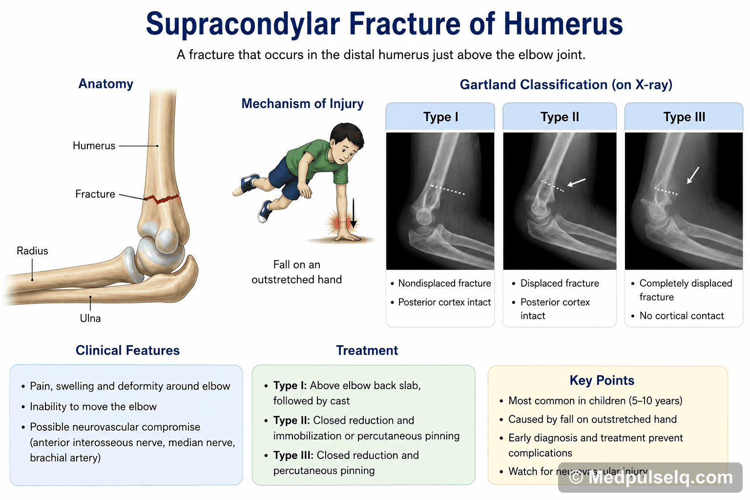 Supracondylar fracture — Orthopaedics