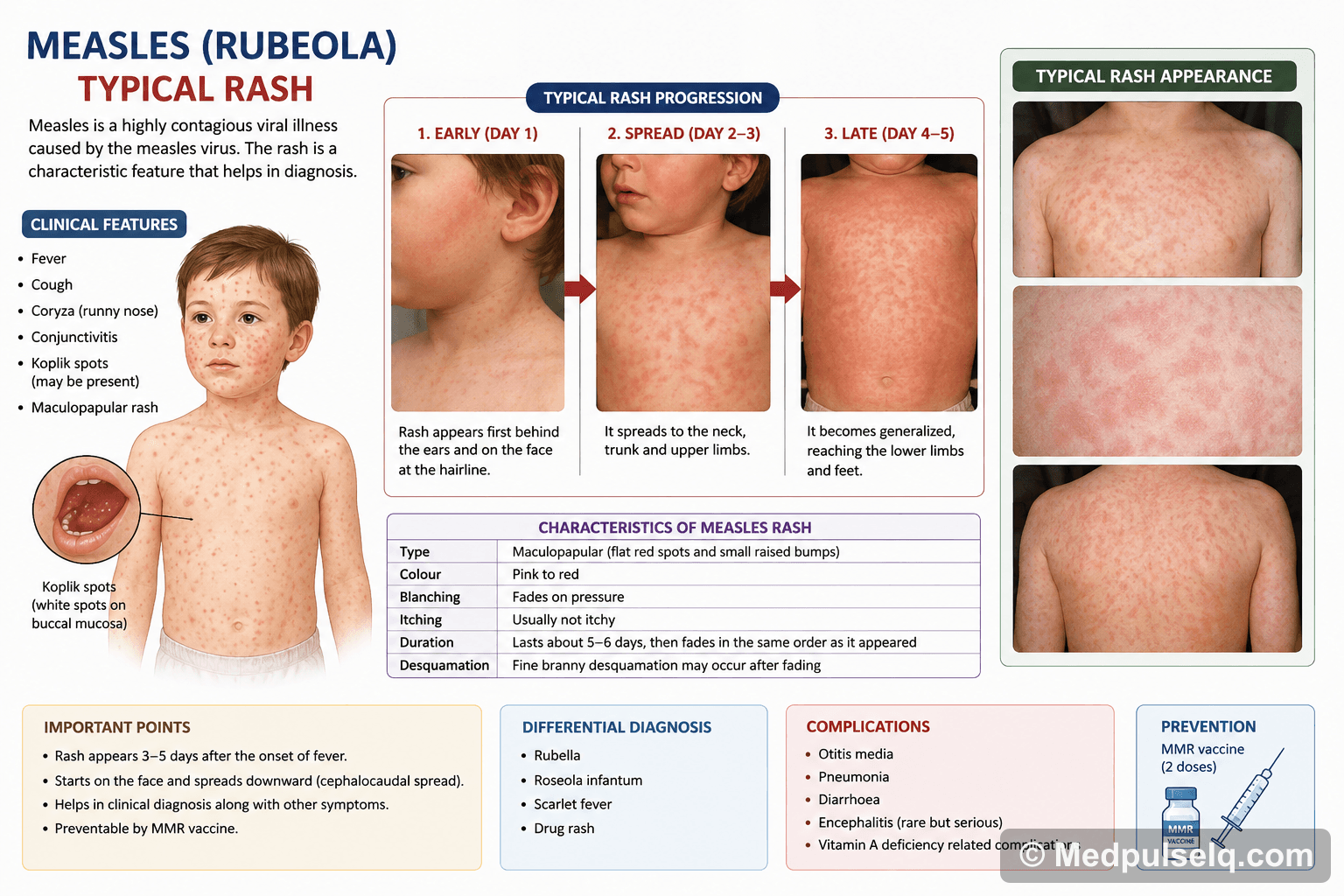 Measles rash — Paediatrics