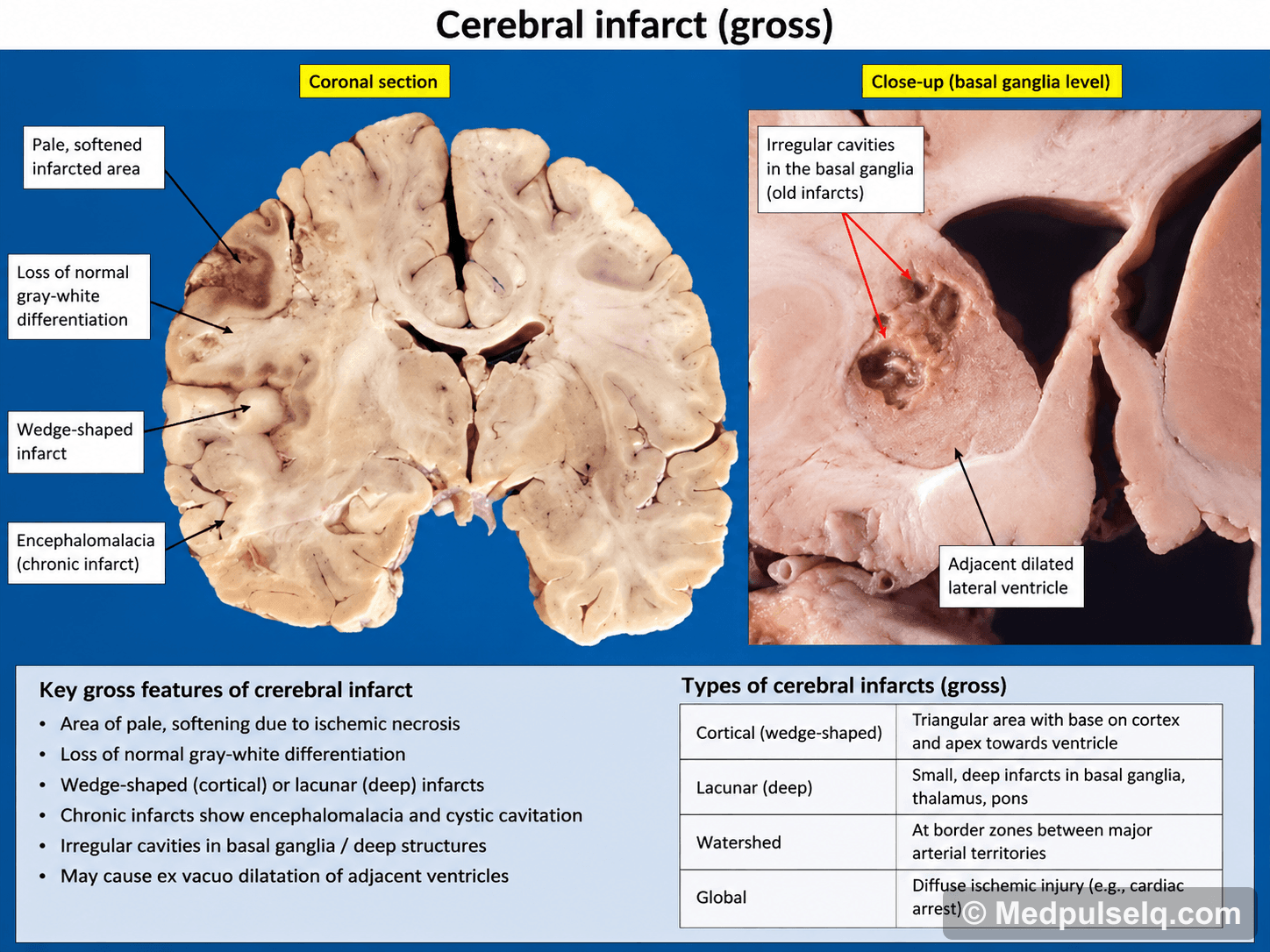 Cerebral infarct (gross) — Pathology