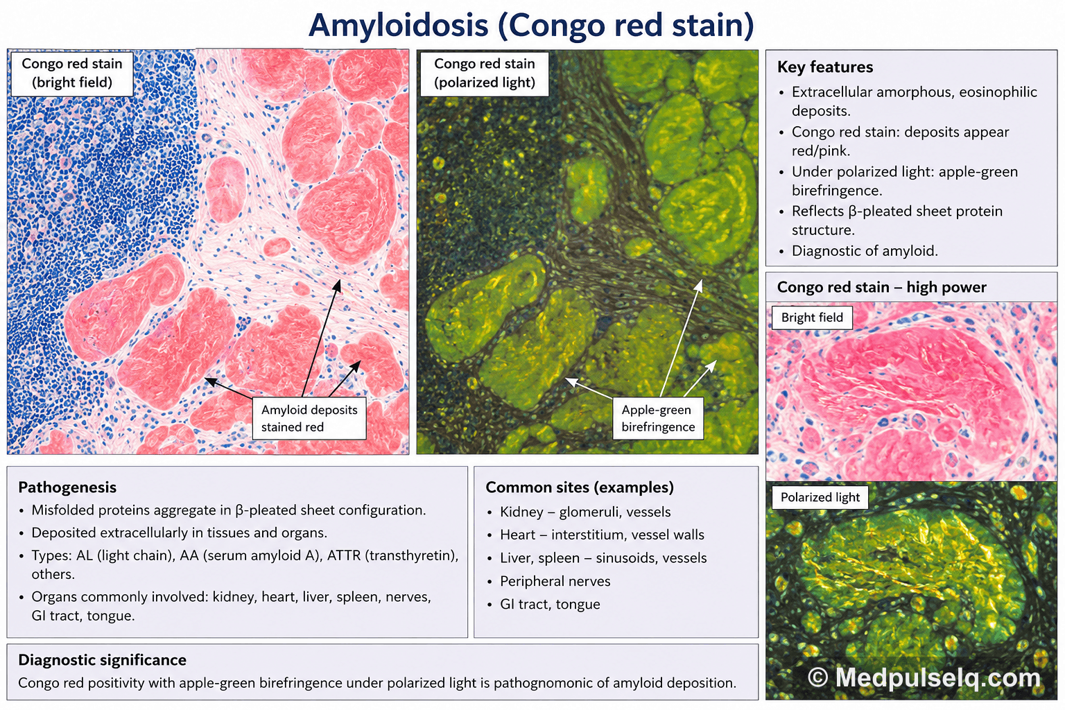 Amyloidosis (Congo red) — Pathology
