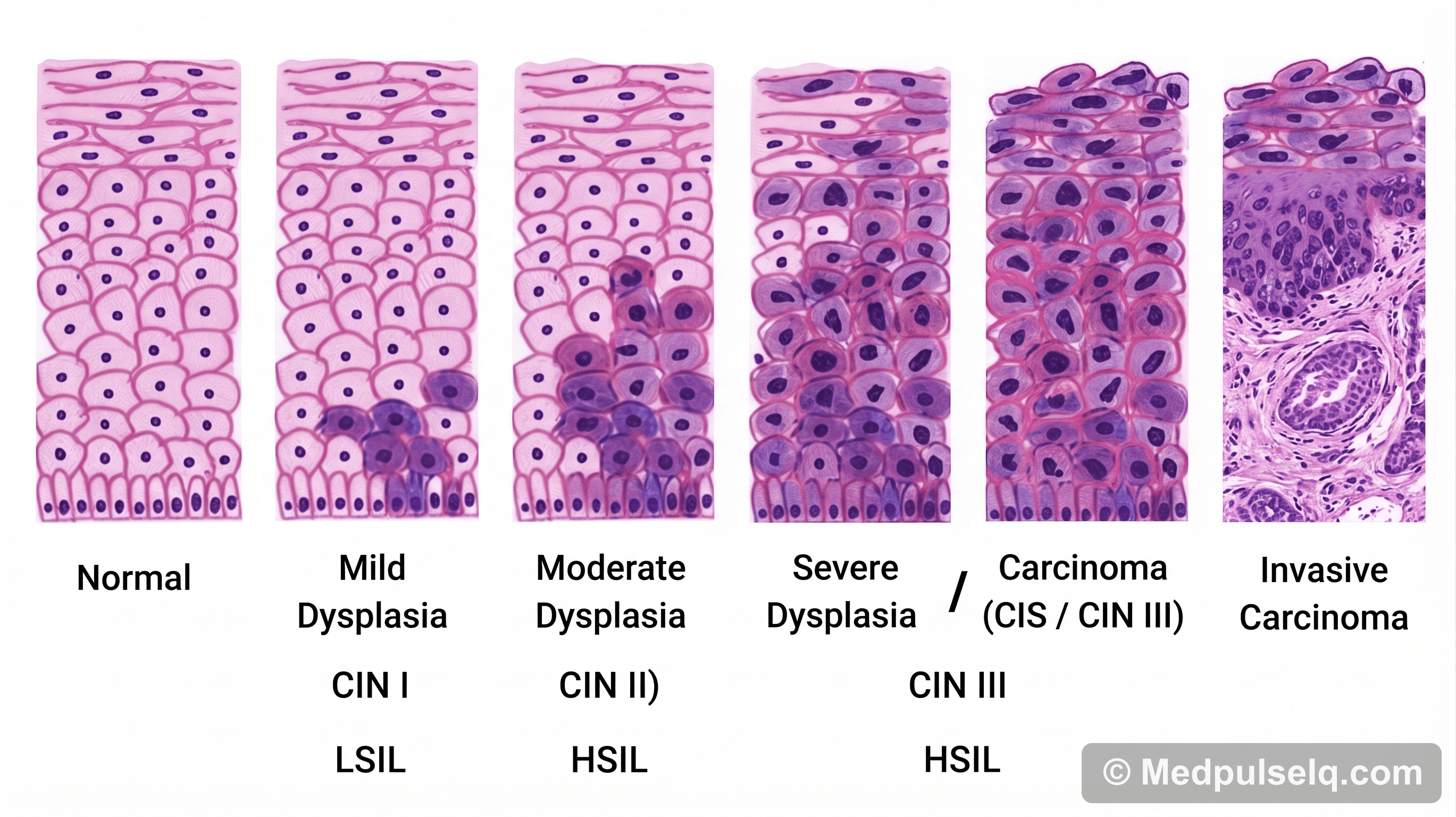 Cervical dysplasia (CIN) — Pathology