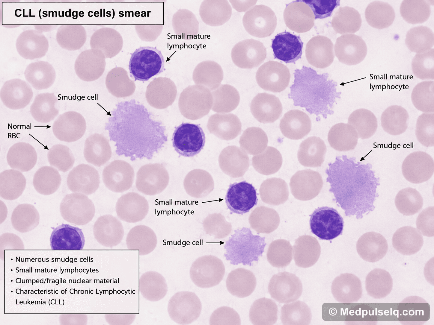 CLL (smudge cells) — Pathology