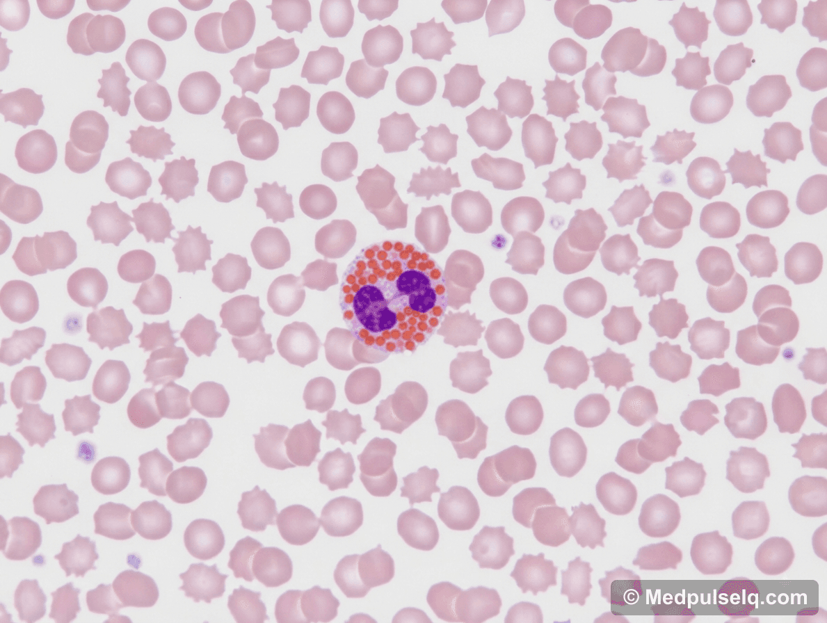 Eosinophil (blood) — Pathology