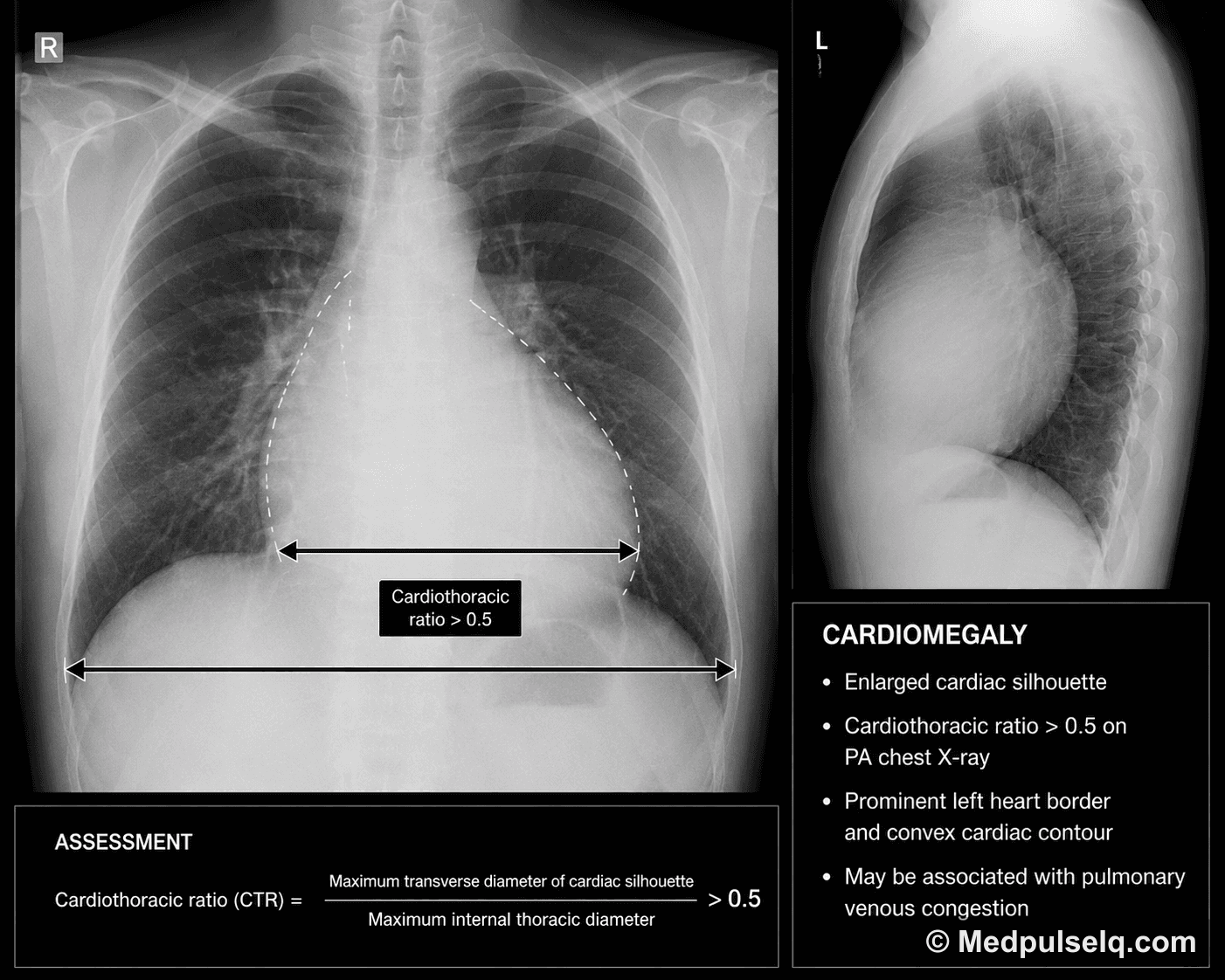 Cardiomegaly — Radiology