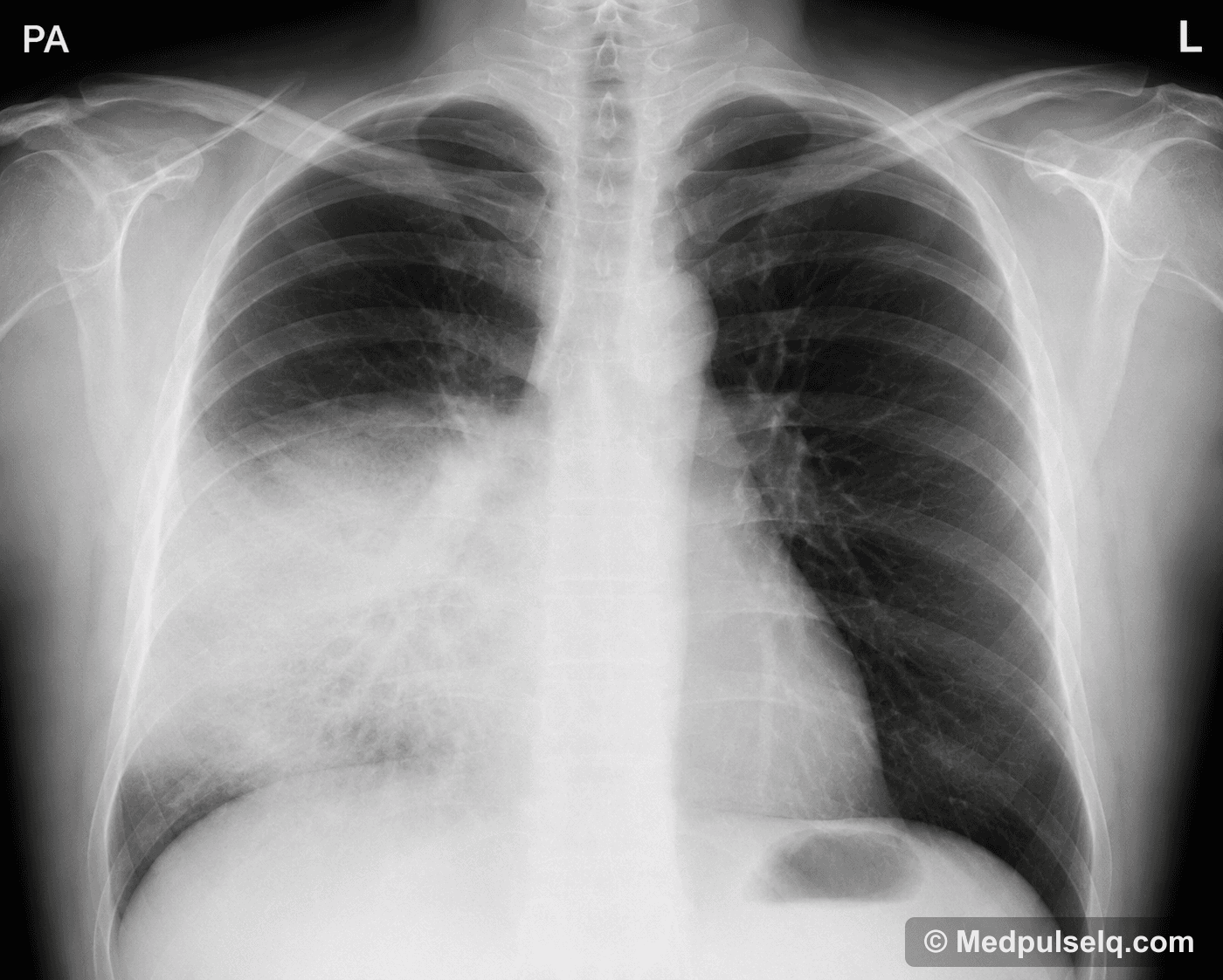Lobar pneumonia (consolidation) — Radiology