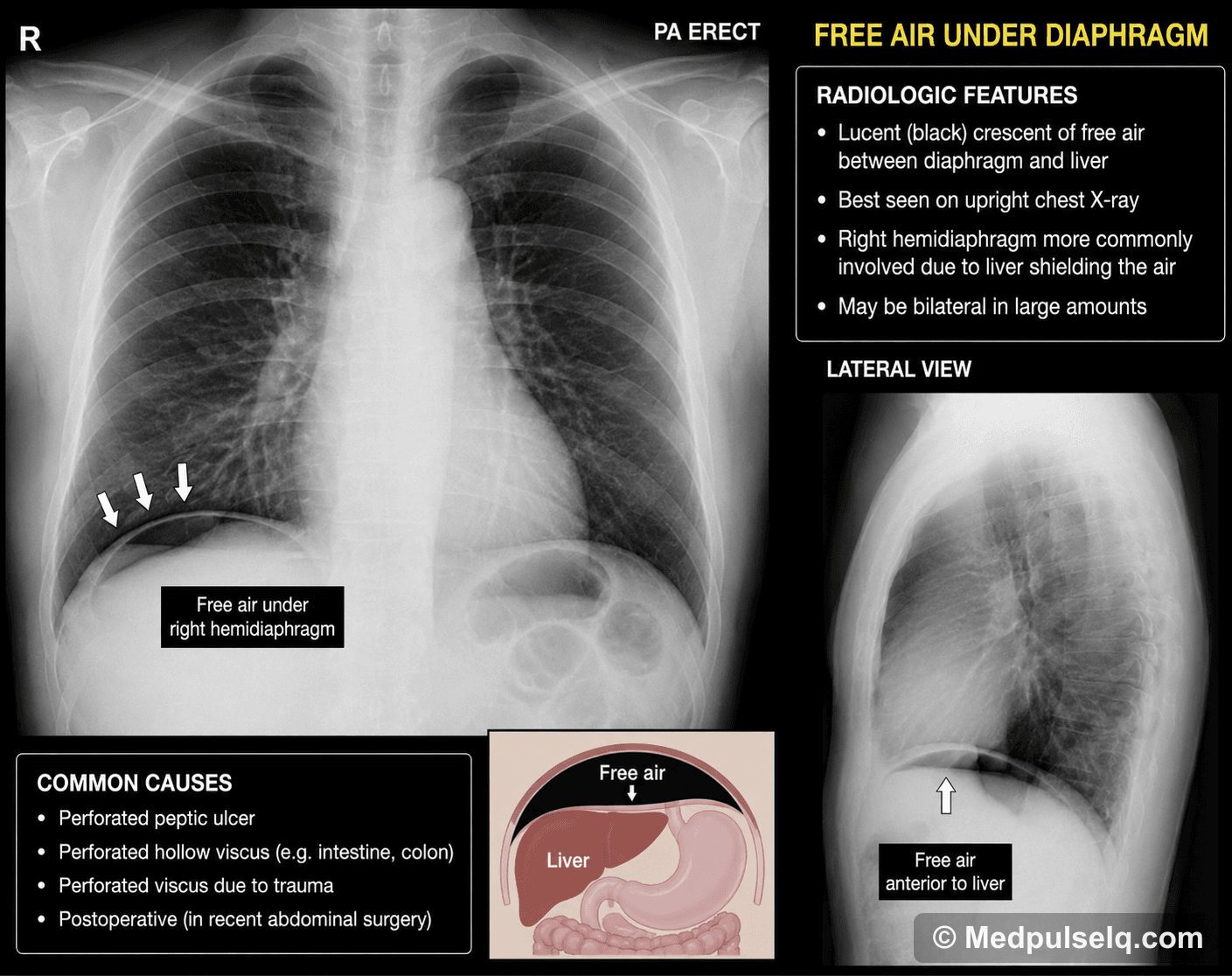 Free air under diaphragm — Radiology