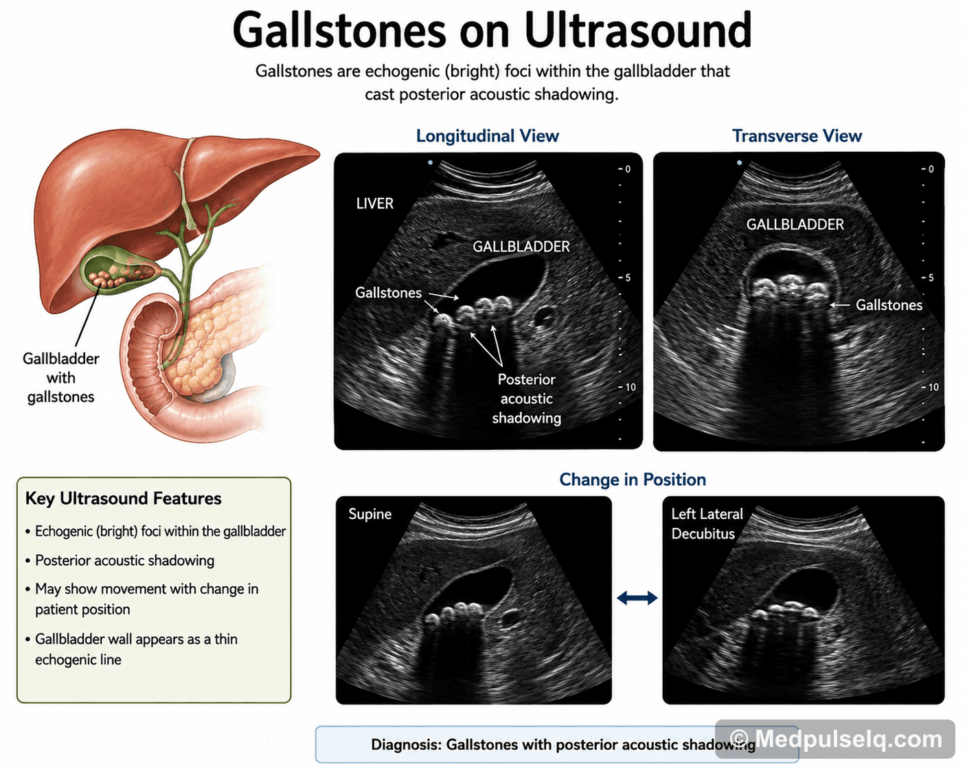 Gallstones on ultrasound — Radiology