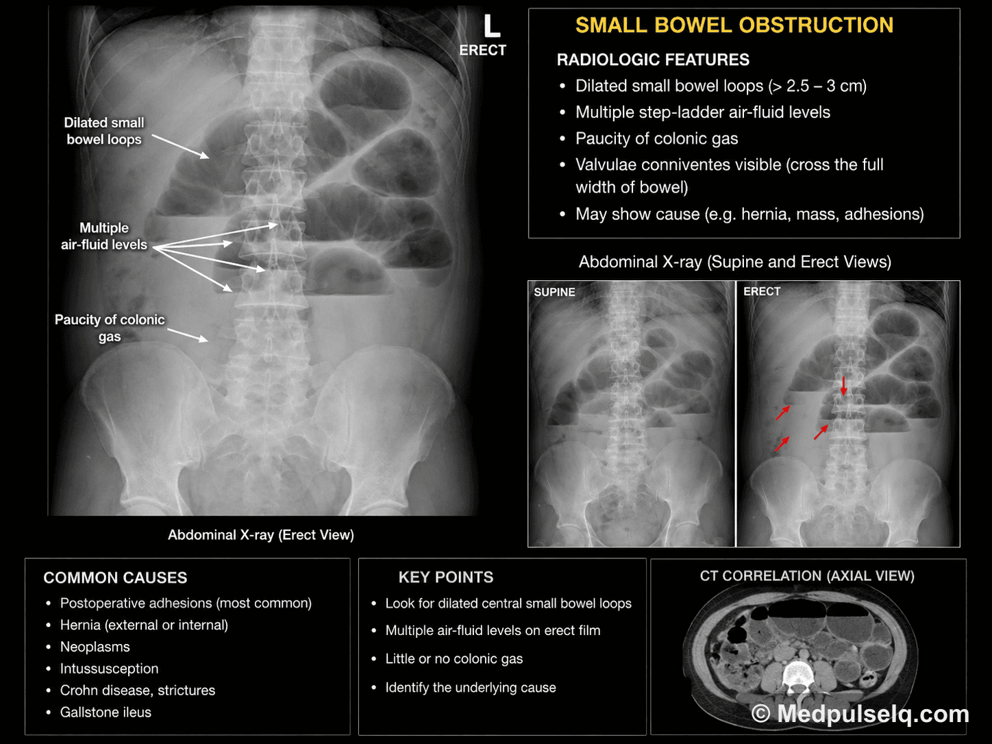 Abdominal radiograph, erect — dilated bowel — Plain radiograph, Erect abdomen