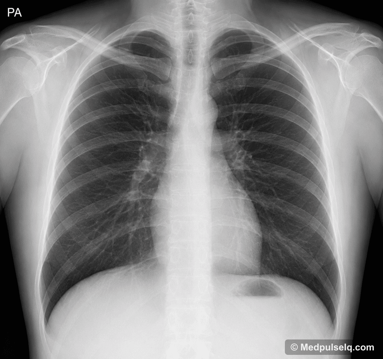 Chest radiograph, PA view — Plain radiograph, Posteroanterior, erect