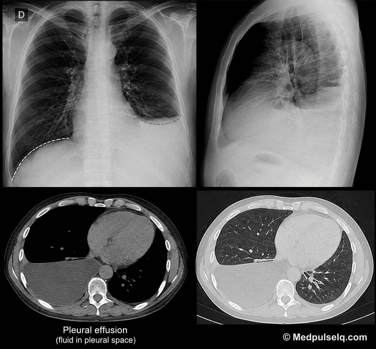Chest radiograph — fluid in the pleural cavity — Plain radiograph, Posteroanterior, erect