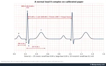 ECG: two normal lead II complexes on standard grid with PR, QRS, QT and RR intervals marked