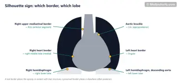 Schematic frontal chest with labelled borders: right upper mediastinum, right heart border, right hemidiaphragm, aortic knuckle, left heart border and left hemidiaphragm, each linked to a lobe