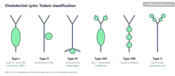 Six schematics of the biliary tree showing choledochal cyst types I, II, III, IVA, IVB and V