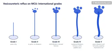 Five schematics of contrast refluxing from bladder into ureter and kidney for grades I to V