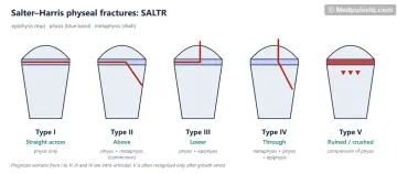 Five schematic bone ends showing fracture lines for Salter–Harris types I to V
