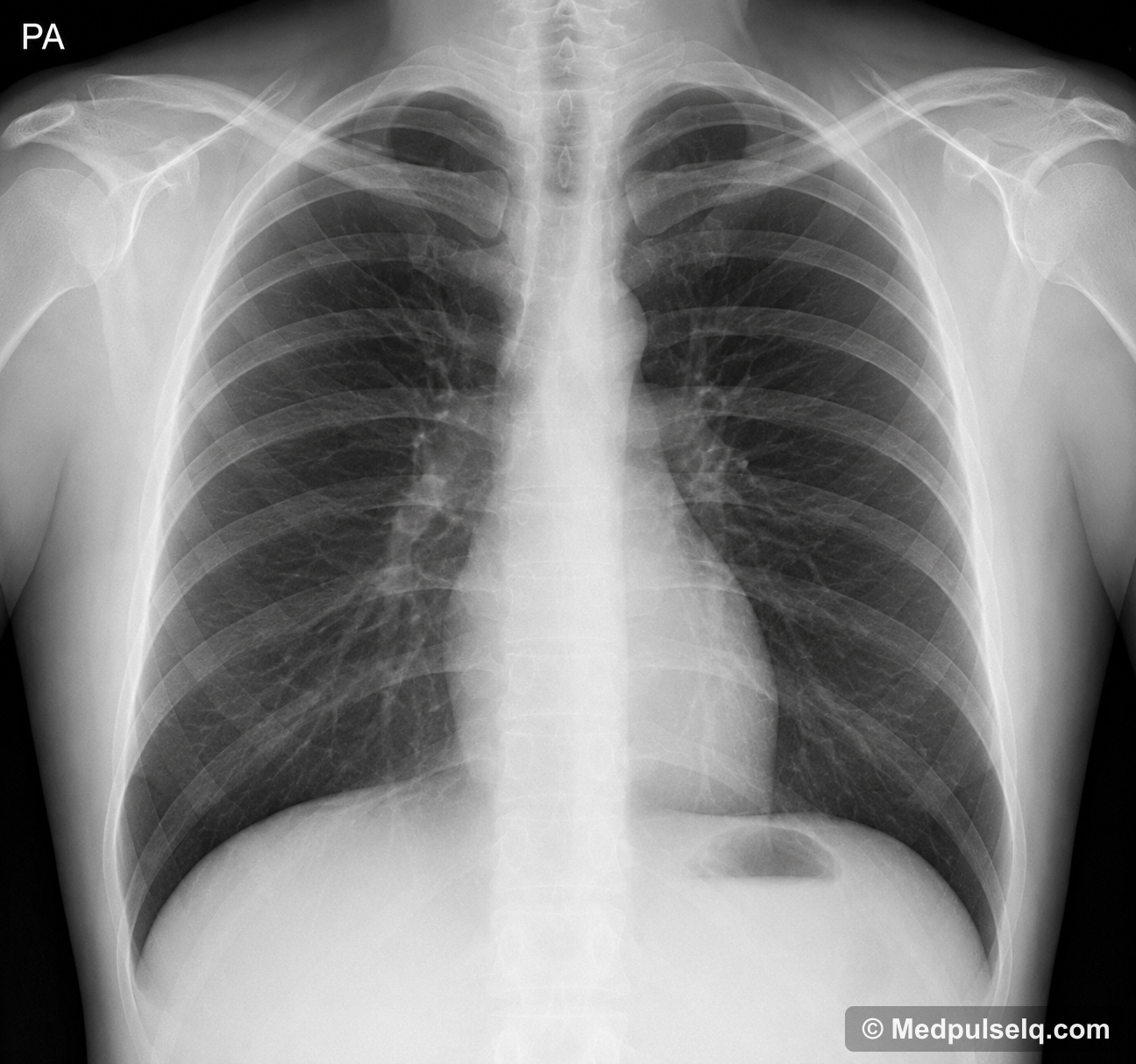 Normal chest X-ray — Radiology